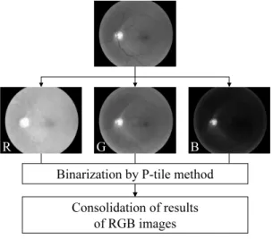 Fig. 5 Procedure of the recognition of optic nerve head. 一方の眼で観察したような画像を擬似的に作成した．例えば，原画像を右目で観察する画像とするならば，左目で観察する画像は，血管画像を右に平行移動して原画像に重ね合わせて作成される．3.結果と考察ディジタル眼底カメラで撮影した眼底画像78枚を用いて実験を行った．画像の内訳は表1に示すように，正常症例は17枚，異常症例は61枚（視神経乳頭部の異常41枚，網膜の異常12枚，白内障8枚）である．異常症例は散