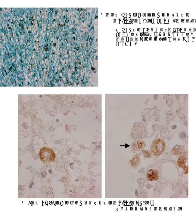 図 8：抗 CD68 マウスモノクローナル抗体（Clone：KP1）と  チールネルゼン染色（肺結核）  抗 CD68 抗体で免疫染色後（DAB 発色）にチールネルゼン染色、ヘマト キシリンで核染色。  組織球細胞質内の結核菌も重染色により観察可能である。  染色上の注意点とポイント １． 免疫染色に アミノエチルカルバゾール（AEC）、4-クロロ-1-ナフトールなどアルコールやキシ レンによる脱水・透徹により退色する発色基質を使用するのは避け、 DAB や脱水可能なアル カリフォスファターゼ発色基質（ファ