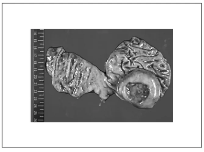 Fig. 5 Abdominal computed tomography revealed a enhanced mass 7cm in size in the delayed phase.