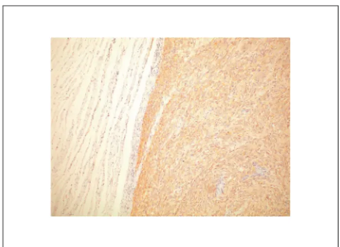 Fig. 7 Microscopic findings showed spindle-shaped cells forming palisades with low cellularity