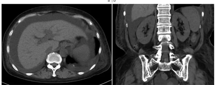 Fig. 2.　Abdominal CT scan without contrast obtained on the 8th day of hospitalization showing massive ascites CT： computed tomography