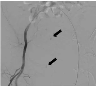 Fig. 4.　 CT angiogram showing active extravasation of arte- arte-rial contrast  （black arrows）