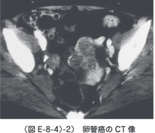 表 層 上 皮 性・間 質 性 腫 瘍（surface epithelial-stromal tumors），性 索 間 質 性 腫 瘍（sex cord"stromal tumors），胚細胞腫瘍（germ cell tumors）の大きく3群に分類され，各々の 全体に占める割合は，表層上皮性・間質性腫瘍60∼70％，性索間質性腫瘍5∼10％，胚 細胞腫瘍15∼20％である．以上の3群それぞれに，良性，境界悪性，悪性腫瘍が存在す る．さらに，卵巣は他臓器癌の転移の好発部位であるため，転移性腫瘍（m