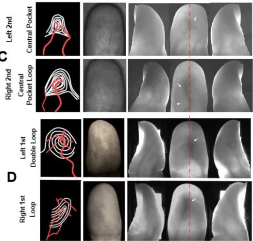 Figure  6.  Comparison  of  the  left  hand  between  right  hand  finger  vein  distribution  and  fingerprint ridge pattern in representative cases of dissidence of fingerprints between left and  right hands
