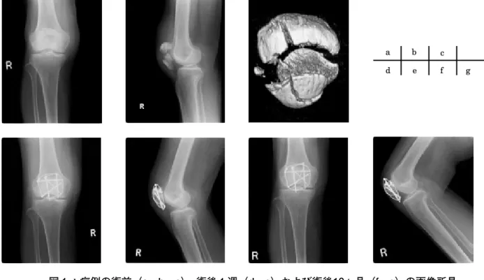 図 1 ：症例の術前（a，b，c），術後 1 週（d，e）および術後10ヶ月（f，g）の画像所見 a，b ：単純 X 線正面および側面像．c： 3 DCT 正面像，右膝蓋骨粉砕骨折を認める．
