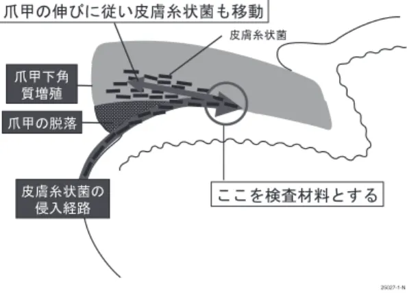 図 1 爪 甲 下 角 質 増 殖 が 見 ら れ る 通 常 の 爪 白 癬 （DLSO）の発症機序と検体採取部位 疑われても，安易に外用抗真菌薬を処方すべきではな い． 「みずむし」を主訴として受診した患者の 13∼33％ が足白癬患者ではなく，その疾患の 7 割以上が湿疹・ 皮膚炎患者だったという報告もある 11） ．従って臨床的 に足白癬以外の疾患を想定できないが，直接鏡検で真 菌が見つからない場合は，ステロイド軟膏を処方し， 1 週間から 2 週間後に再受診させ，もう一度直接鏡検 を行う．湿疹・皮