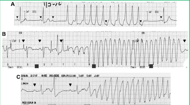 図 1  心室頻拍の心電図（P 波の位置を▼で示す）  A:  3 拍目より QRS 波形が一定の wide  QRS  tachycardia （11 連発）が記録されています．QRS の軸は洞調律時 と同じですが，頻拍中に房室解離が認められ．診断は 非持続性の単形性心室頻拍です．  B:  4 拍目の心室性期外収縮に引き続き wide  QRS  tachycardia（27 連発）が記録されています．頻拍中に QRS 軸が変化しており（初めの 4 拍は上向き，残りは 下向き），診断は非持続性の多型性心