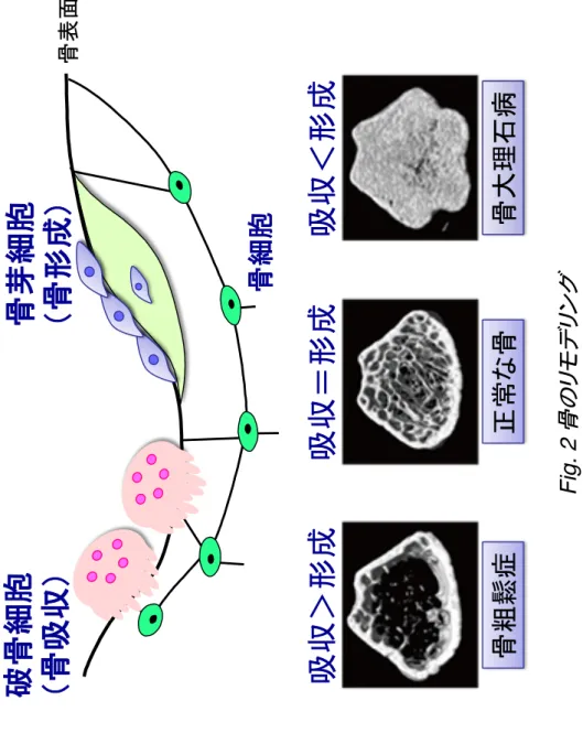 Fig. 2 骨のリモデリング�骨細胞 破骨細胞 （骨吸収）骨芽細胞 （骨形成） 吸収＞形成 骨粗鬆症吸収＜形成骨大理石病吸収＝形成正常な骨骨表面