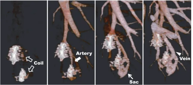Figure 2  Four-dimensional (4D) CT suggesting recanalization of the ﬁstula in left S10 from left A10b