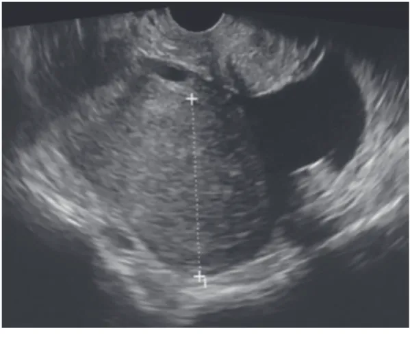 図 1 経腟超音波所見 6 cm の単房性で腫瘍全体が充実性成分であった． 図 2 造影 MRI 所見 A：T2 強調画像で境界明瞭を認めた（◁）． B：T2 強調画像で辺縁に高信号，中央に低信号を認めた（▷）． C：脂肪抑制 T1 強調画像で高信号領域に造影効果を認めた（▷）． 図 3 病理組織所見 A，B：肉眼所見，C：HE 染色 200 倍 内膜腺上皮類似の異型腺管の増殖あり腺管状，癒合腺管を成して増殖し扁 平上皮を伴っているが充実成分はみられなかった（grade 2）．
