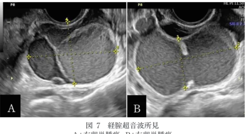 図 7 経腟超音波所見 A：右卵巣腫瘍，B：左卵巣腫瘍 両側とも多房性，low echo であり子宮内膜症性嚢胞が疑われた． 図 8 造影 MRI 所見（左卵巣腫瘍） A：T2 強調画像で淡い高信号であった（◁）． B：T1 強調画像で淡い高信号であった（▷）． C：脂肪抑制 T1 強調画像では充実部分を認めた（◁）． 図 9 病理組織所見 A：肉眼所見，B：HE 染色 200 倍 粘液性胞体を有する円柱上皮に覆われている，乳頭状増殖があり一部核腫大し重積性 増殖がみられたため粘液性境界悪性腫瘍の診断となっ
