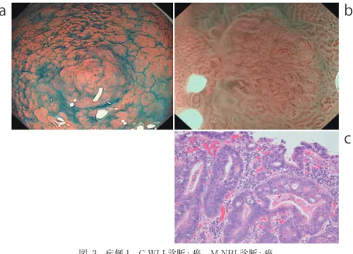 図 3 症例 1 C-WLI 診断 : 癌，M-NBI 診断 : 癌 a：通常内視鏡像（インジゴカルミン色素散布併用） b：NBI 併用拡大内視鏡像（強拡大） c：病理組織像（HE 染色，200 倍）a c b a c db 図 4 症例 2 C-WLI 診断：非癌，M-NBI 診断：癌 a：通常内視鏡像，b：NBI 併用拡大内視鏡像（弱拡大）， c：NBI 併用拡大内視鏡像（強拡大），d：病理組織像（HE 染色，200 倍）