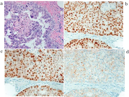 Fig. 1　  Gross appearance of the specimen from a breast pre- pre-serving surgery. The resected specimen of the lower  inner quadrant of the right breast measured 6.0 cm