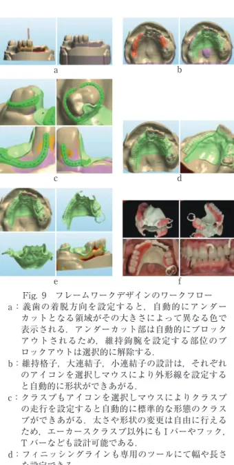 Fig. 7 a：LAVA C. O. S. 口腔内スキャナーによる光学印象採得 b：光学印象採得した三次元モデルのトリミング c：CAD ソフトウェア上で再現された作業用模型 d：CAD ソフトウェア上でデザインされるジルコニア コーピング e：CAD ソフトウェアを元に製作された SLA モデルと ジルコニアコーピング f ：技工士がポーセレンを築盛して完成させたオールセ ラミッククラウン Fig. 9 フレームワークデザインのワークフロー a：義歯の着脱方向を設定すると，自動的にアンダーカットとなる領