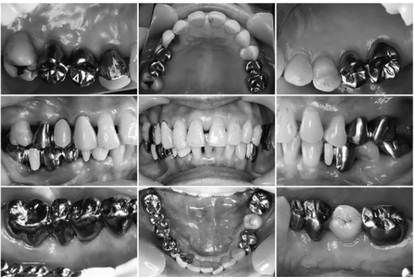 図 7　メインテナンス移行 8 か月後の口腔内写真（2013 年 12 月） 歯肉の発赤および腫脹は認められなかった． 図 8　メインテナンス移行 8 か月後の歯周組織検査（2013 年 12 月） ポケット深さは，3 mm 以下が 99.3％，4 ～ 6 mm が 0.7％，7 mm 以上が 0％であり，BOP 陽性率は 0.7％であった．PCR は 3.0％であった． 図 9　メインテナンス移行 8 か月後のデンタル X 線写真（2013 年 12 月） 全顎的に骨の平坦化と，明瞭な歯槽硬線が認められた
