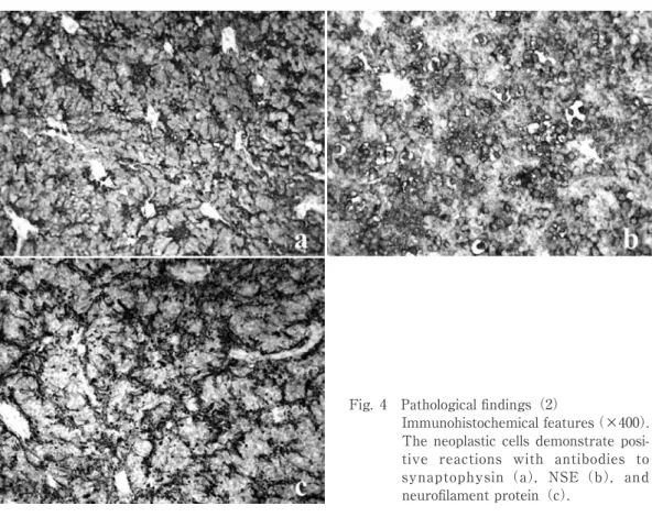 Fig. 5 The postoperative MR image T1-weighted MR image after   administration of gadolinium-DTPA  shows  the  subtotal  removal of the tumor.