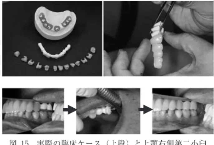 図 15   実際の臨床ケース（上段）と上顎右側第二小臼 歯と第一大臼歯部破折時の修復手順（下段）