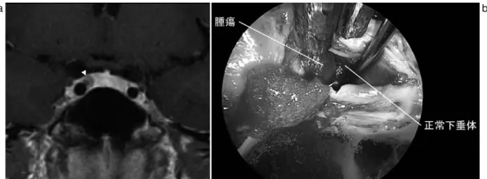 Fig. 4  症例 1 の MRI 画像造影 T1 強調画像冠状断（a）と術中写真（b）．腫瘍被膜が観察され腫瘍を被膜ごと摘 出した．