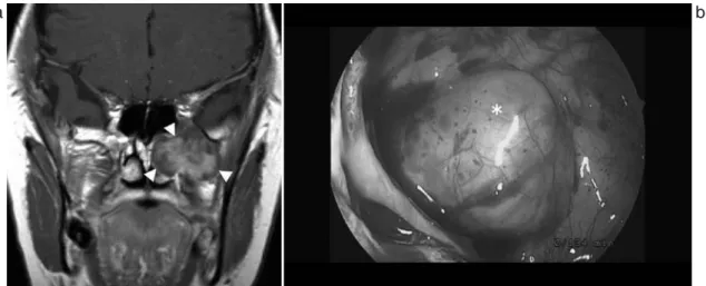 Fig. 6  症例 3 の MRI 画像造影 T1 強調画像冠状断（a）と術中写真（b）．左上顎洞を経由して上顎洞 後壁において腫瘤（＊）に到達． Fig. 7  症例 4 の MRI 画像造影 T1 強調画 像冠状断（a），矢状断（b）と術中 写真（c）．蝶形骨洞下外側を削除， 上顎洞後壁を削除することによっ て直視下に腫瘍（＊）を摘出可能 であった． bac