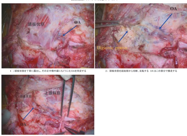 Fig. 6 Case 1 Fig. 5 OA 剥離
