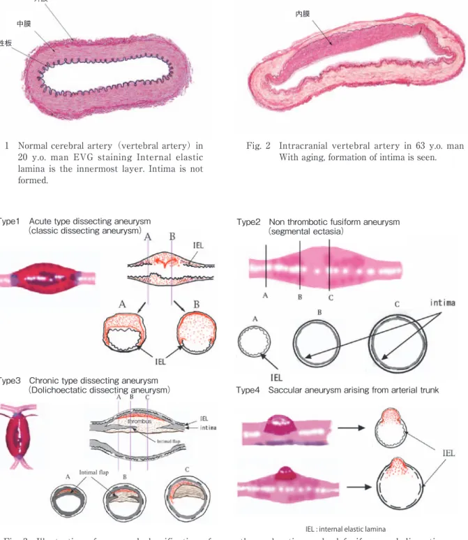 Fig. 3  Illustration  of  proposed  classification  of  non  atherosclerotic  cerebral  fusiform  and  dissecting  aneurysms presented by the author Type4 Saccular aneurysm arising from arterial trunkType3 Chronic type dissecting aneurysm （Dolichoectatic d