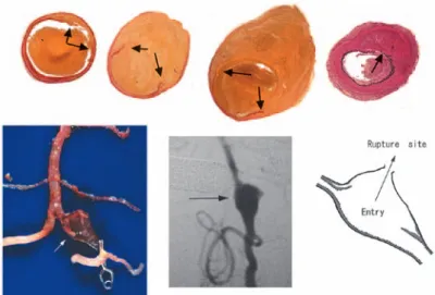Fig. 5  Left vertebral artery dissecting aneurysm which  presented  SAH  in  45  y.o.  man.  A  Slice  at  the  rupture point（AZAN staining）