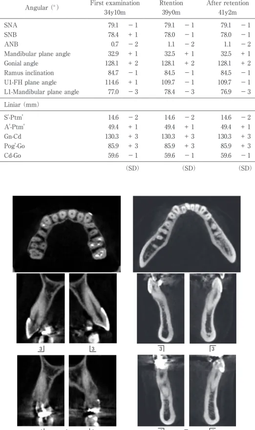 Table 2 Lateral cephalometric analysis Angular （°） First examination  34y10m Rtention39y0m After retention 41y2m SNA 79.1  − 1 79.1  − 1 79.1  − 1 SNB 78.4  ＋ 1 78.0  − 1 78.0  − 1 ANB 0.7  − 2 1.1  − 2 1.1  − 2 Mandibular plane angle 32.9  ＋ 1 32.5  ＋ 1 3