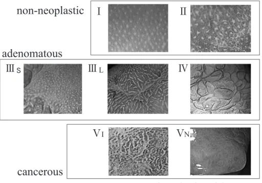 図 3　Pit pattern classiﬁcation with crystal violet 表 3　Gross appearance and pit pattern