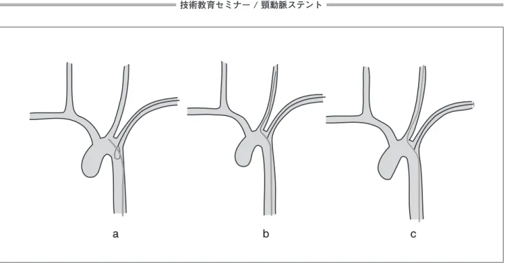 図 4  スネアーワイヤーを用いたガイディングカテーテルの誘導 a :  ガイディングカテーテルをスネアーに通す。 b : スネアーワイヤーでガイディングカテーテルを保持し，ガイドワイヤーを外頸動脈にすすめる。 c : ガイディングカテーテルを保持したまま，ガイドワイヤーに沿ってガイディングカテーテルを総頸動脈に進める。 図 5  ダブルワイヤー法によるガイディングカテーテルの誘導 a : 右上腕動脈からカテーテルを右腸骨動脈に誘導し，ガイドワイヤーを右大腿動脈に挿入したシース内に進める。 b : ガイドワ