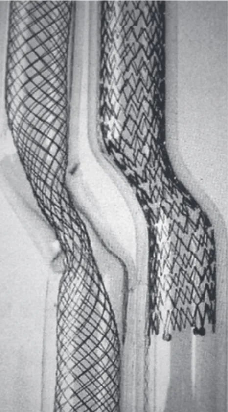 図 8  SMART stent（右）と Wallstent（左）の利点と欠点