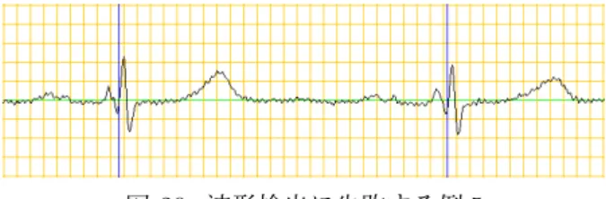 図 20: 波形検出に失敗する例 5 図 19 および 20 に示された波形は，R 波の電位の特 殊性によって正しい検出が行われない．上図はいずれ も R 波が下に凸である波形であるが，近傍に同等また はそれ以上 (上に凸である波を含む) の電位を持つ R で ない波の存在によって，検出されるべき R 波が誤検出 または未検出となる． 図 21: 波形検出に失敗する例 6 図 21 に示された波形は，しきい値を超える区間 1 か 所のうち，局所的に最大の電位が 2 点存在することに よって一部の R 波が正