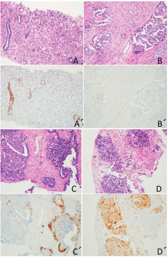 Fig. 1   Immunostaining to show various levels of PTEN expression. A, B, C, D are hemato- Fig. 1   Immunostaining to show various levels of PTEN expression. A, B, C, D are hemato-xylin-eosin staining. A  is no PTEN expression on cancer tissue（intensity＝0）.