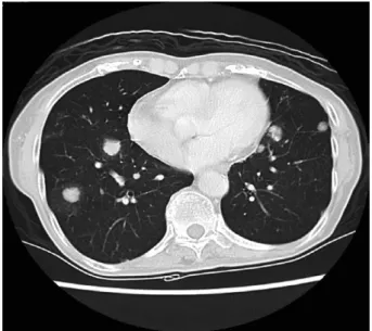 Fig. 4   Pulmonary  contrast-enhanced  computed  tomography showed multiple nodules in both  lung ﬁelds.