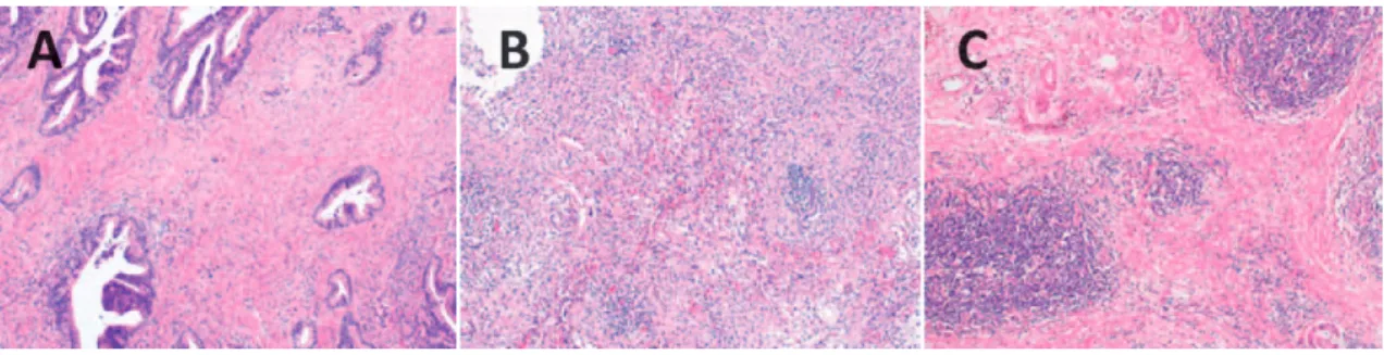 Fig. 3.  The  degree  of  inflammation  of  the  tumor  stroma  was  categorized  into  three  grades :  （A）   mild  （0） , 