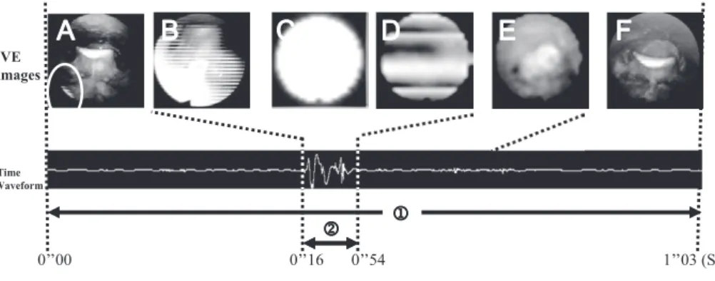 Fig. 2.  Examples  of  total  swallow  duration  and  swallowing  sound  duration