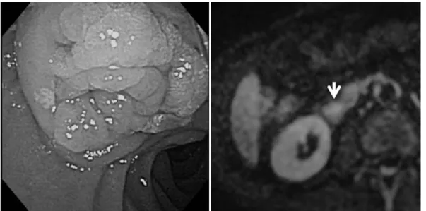 Fig. 2.  Endoscopy  and  diffusion-weighted  magnetic  resonance  imaging  of  Case  8  （cancer  in  adenoma） 