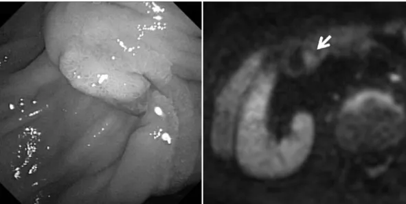 Fig. 3.  Endoscopy  and  diffusion-weighted  magnetic  resonance  imaging  of  Case  10