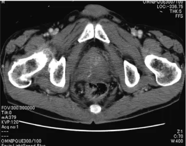 Transurethral Resection is an Efficacious Surgical Option for Patients ...