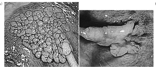 Fig. 1.  Endoscopic  appearance  of  a）   granular-type  laterally  spreading  tumor  （LST-G）   and  b）