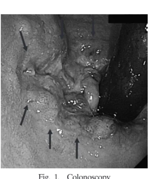 Table 1.  Tumor  marker  of  CEA  and  SCC Before  CRT After  CRT CEA  （ng / ml） 1.1 0.9 SCC  （ng / ml） 0.8 0.6