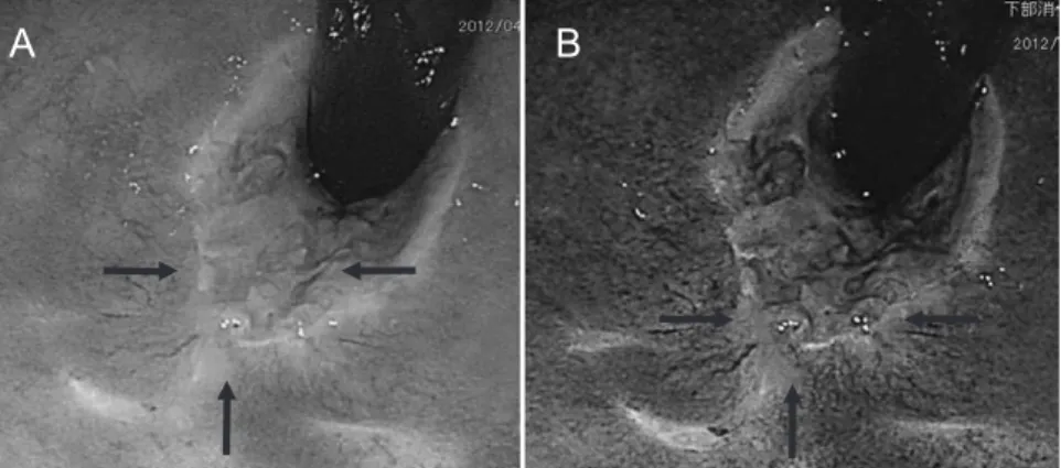 Fig. 4.  Computed  tomography  at  4  weeks  after  the  completion  of  chemoradiotherapy CT  showing  no  evidence  of  lymph  node  or  distant  metastases,  as  was  the  case  on  the  initial  computed  tomography.