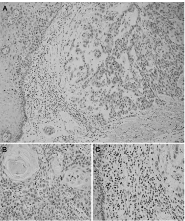 Fig. 1.  Representative  immunohistochemical  staining  A）   Tumor  nests  （intra-tumor  compartment）   and  surrounding 