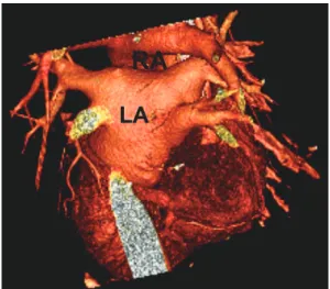 Fig.  1.     Three-dimensional  renderings  of  left  atrium  and  pulmonary  veins.
