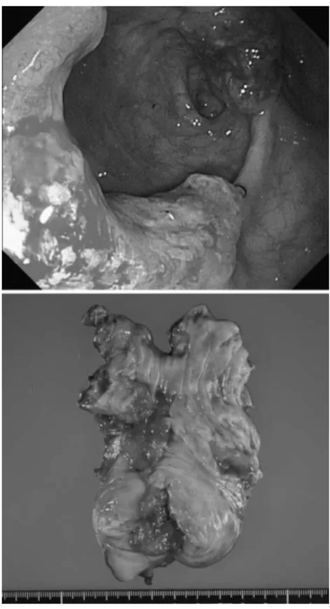 Fig. 5  Second anastomotic recurrence was  suspected by follow up colonoscopy. 