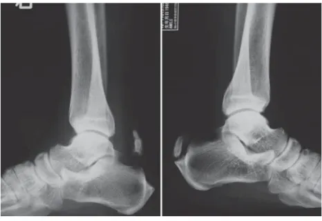 Fig. 1 X-ray showed fracture of ossiﬁ ed Achilles tendon.