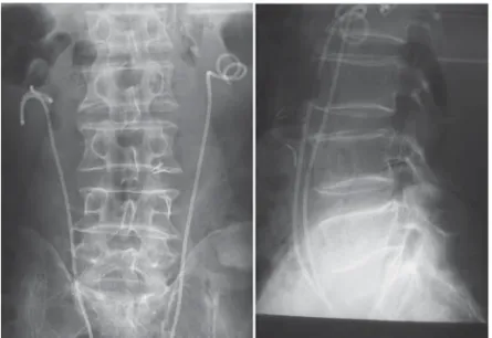 Fig. 1  Lumber  Spine  x-ray :  This  ﬁ lm  shows  stents  for  ureters  and  degenerative bone changes.