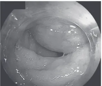 Fig. 1  Double  balloon  endoscopy  examination  re- re-vealed  a  submucosal  tumor  in  distal  ileum  about 10 cm from the ileocecal valve, so the  scope could not pass.