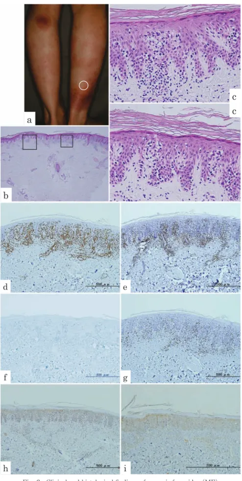 Fig. 2 Clinical and histological ﬁ ndings of mycosis fungoides （MF）