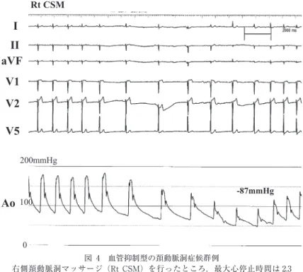 図 4 血管抑制型の頚動脈洞症候群例 右側頚動脈洞マッサージ（Rt CSM）を行ったところ，最大心停止時間は 2.3 秒に留まったが，収縮期血圧は 87 mmHg 低下し，意識消失発作が誘発され， 血管抑制型と診断された． 表 3 頚動脈洞症候群に対するクラス分類による治療法（日本循環器学会ガイドライン） （文献 11 より引用） クラスⅠ 1）病態の説明 2）誘因を避ける：急激な頚部の回旋・伸展，きつい襟，きついネクタイなど 3）頚部腫瘍の摘除 4）失神を伴う心抑制型に対するペースメーカー（DDD，DDI