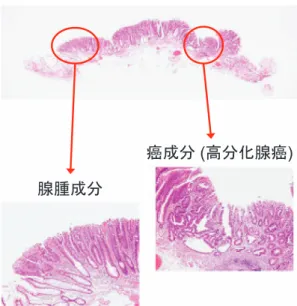 図 2 隆起性早期大腸癌（Type 0, I p, pSM）例 腺腫成分と高分化腺癌成分を同時に認め，後者は粘 膜下層にも浸潤（○内）している． 図 4 平坦型早期大腸癌（Type 0, IIa, pSM）例 腺腫成分と高分化腺癌成分を同時に認め，後者は粘膜下層にも浸潤（○内）している．図 1 隆起型早期大腸癌（Type 0, I sp, pM），腺腫内癌例粘膜層内に限局して腺腫成分（左○内）と高分化腺癌成分（右○内）を認める．図 3 平坦型早期大腸癌（Type 0, IIa, pM）例粘膜内に限局して腺腫